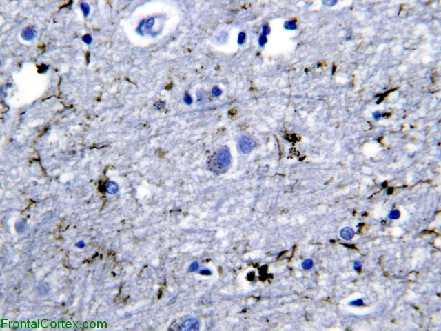 PS1 familial Alzheimer's disease, cotton-wool plaque, tau immunohistochemistry